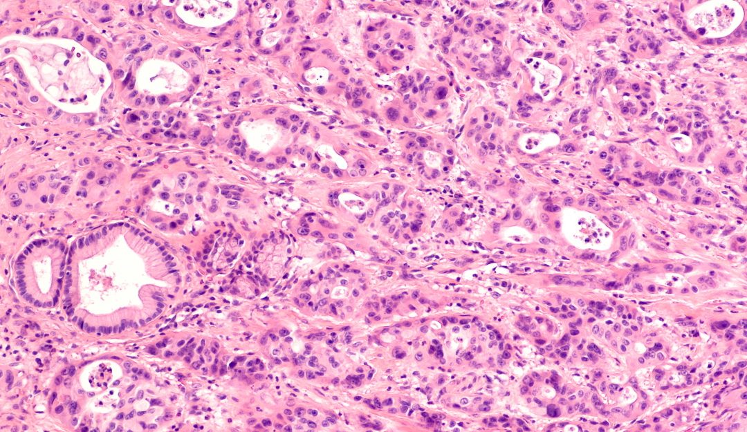 Detecting pancreatic disease using artificial intelligence and human ingenuity