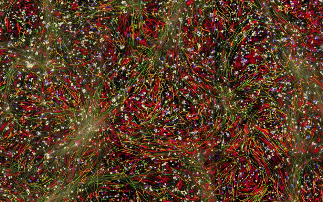 Could the brain’s over-eager ‘pruning shears’ be causing schizophrenia?